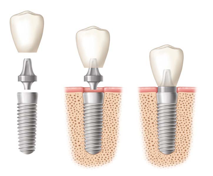 DENTAL IMPLANTS IN LUDHIANA DR. GOYAL'S DENTAL CLINIC