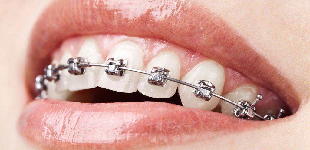 Damon Braces