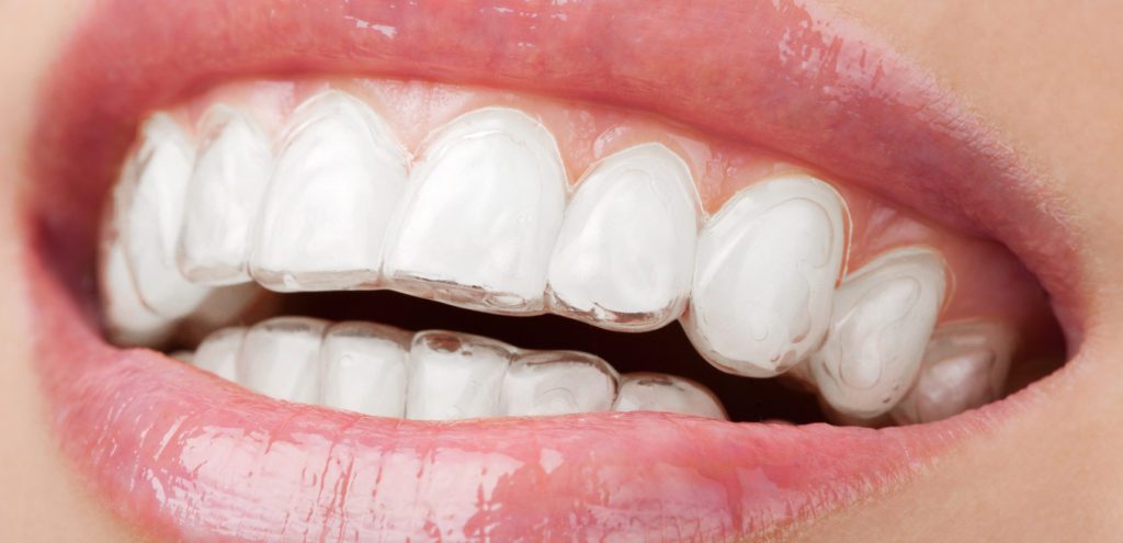 Affordable Invisalign In Ludhiana