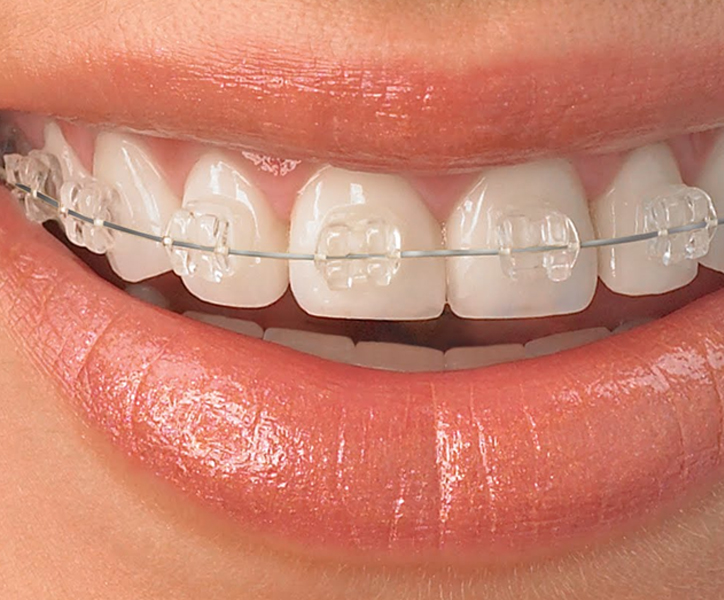 Best Braces Dental Treatment in Ludhiana