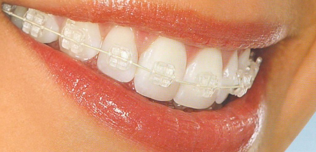 Ceramic Braces Ludhiana