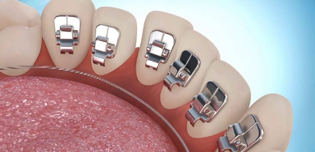 Lingual Braces in Ludhiana