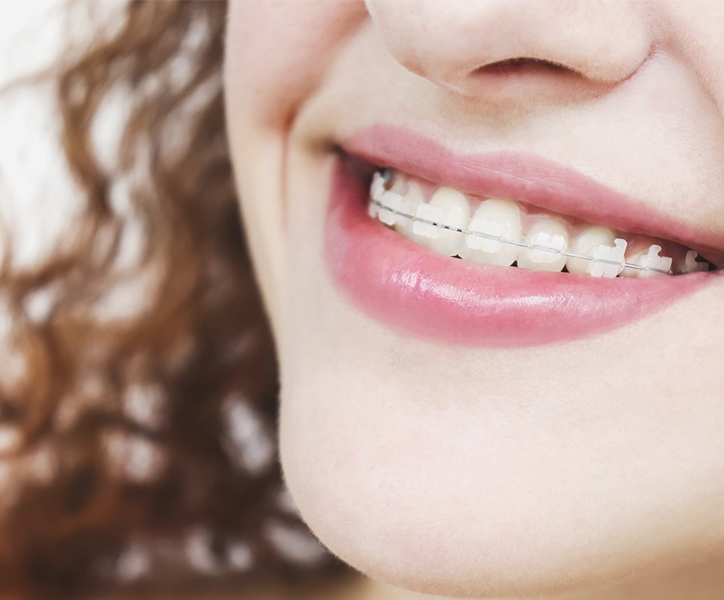 Best Ceramic Braces in Ludhiana