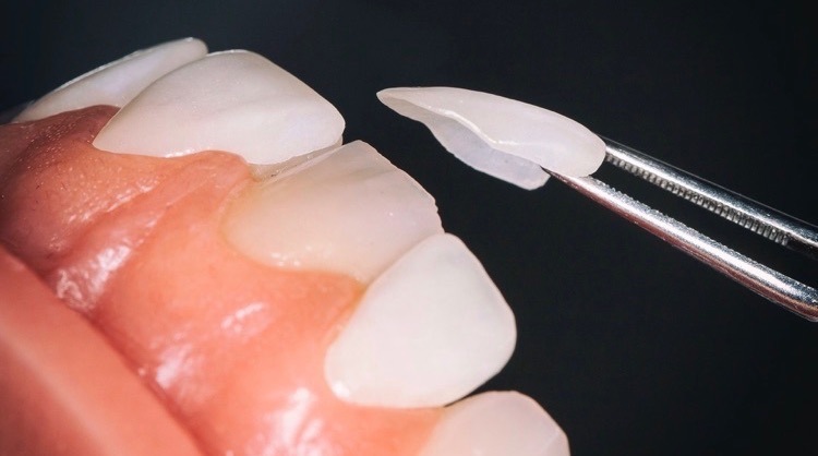 Dental Veneers