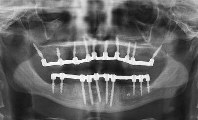 Basal Implants in Luhiana