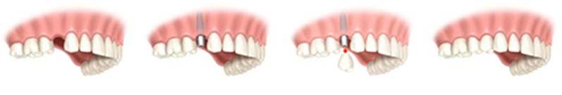 Screw teeth