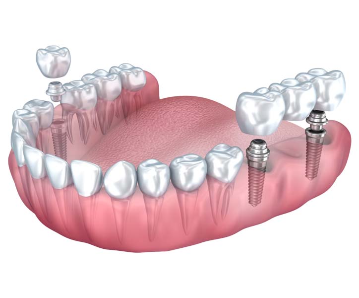 Implant Teeth