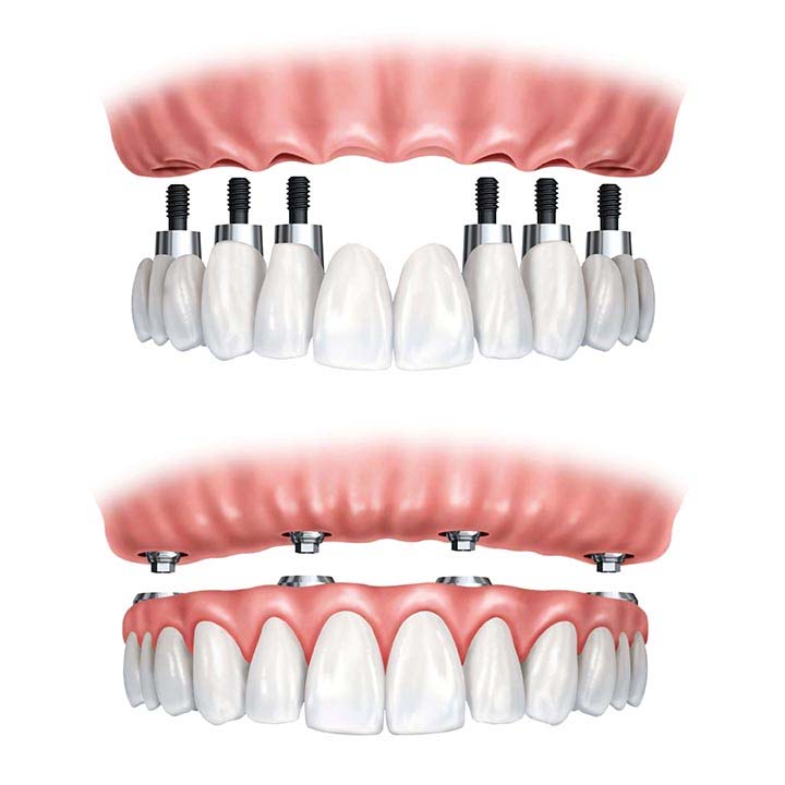 All on Six Implants