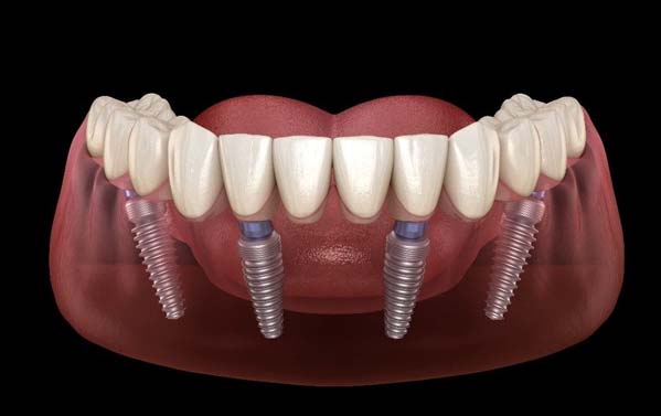 All on Four Implants