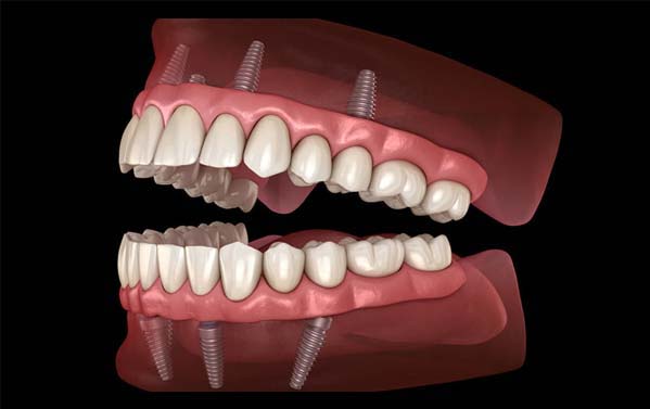 Permanent Fix Teeth