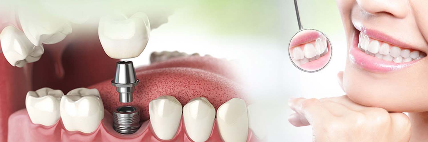 DENTAL IMPLANTS IN LUDHIANA DR. GOYAL'S DENTAL CLINIC